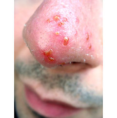 herpes