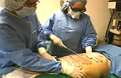 laser liposuction