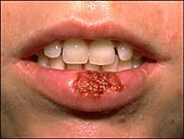 I Have A Cold Sore! Do I Have Herpes?