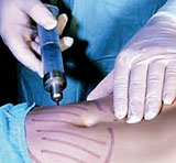 What’s The Best Liposuction Method? What’s The Best Liposuction Method?