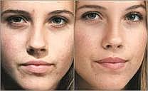 Magic Behind Acne Scar Treatment