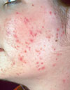 3 Things You Should Know About Acne Treatment